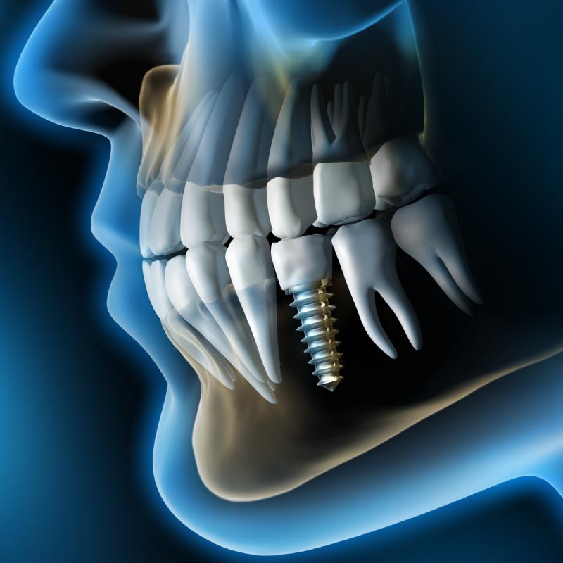 impianto-dentale-fisso
