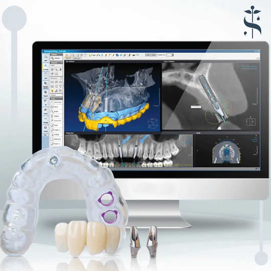 Implantologia Computer Guidata - Chirurgia Orale
