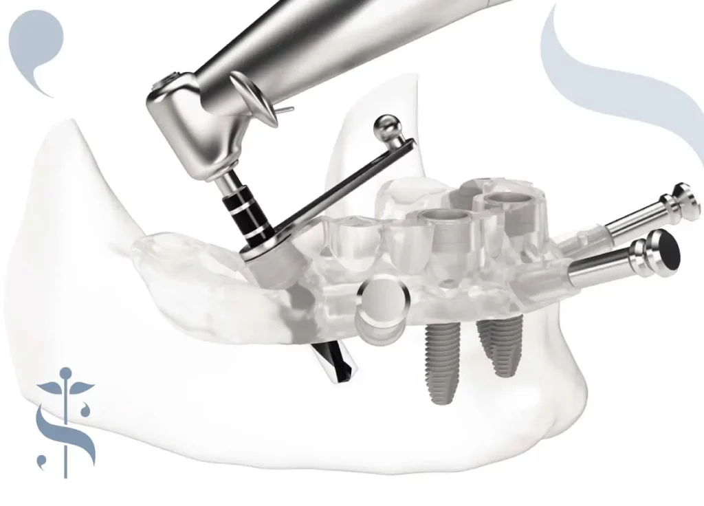 implantologia computer guidata - chirurgia computer guidata impianto dentale fisso