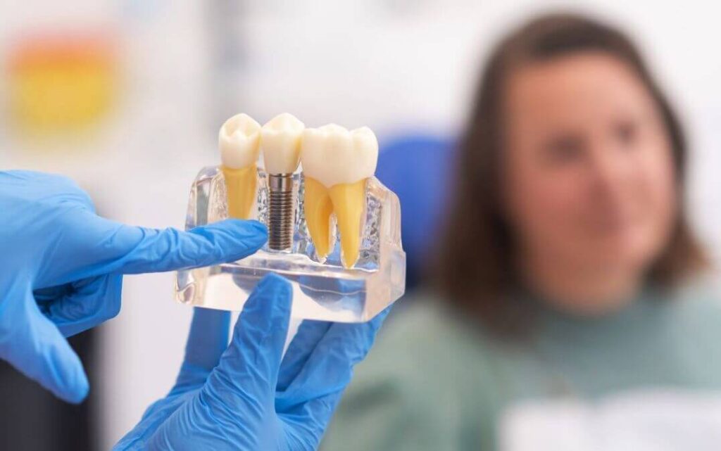Quali sono i migliori materiali per gli impianti dentali
