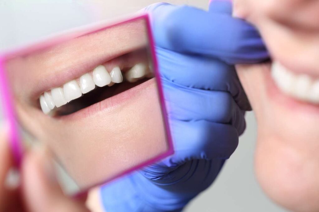 Come prendersi cura degli impianti dentali