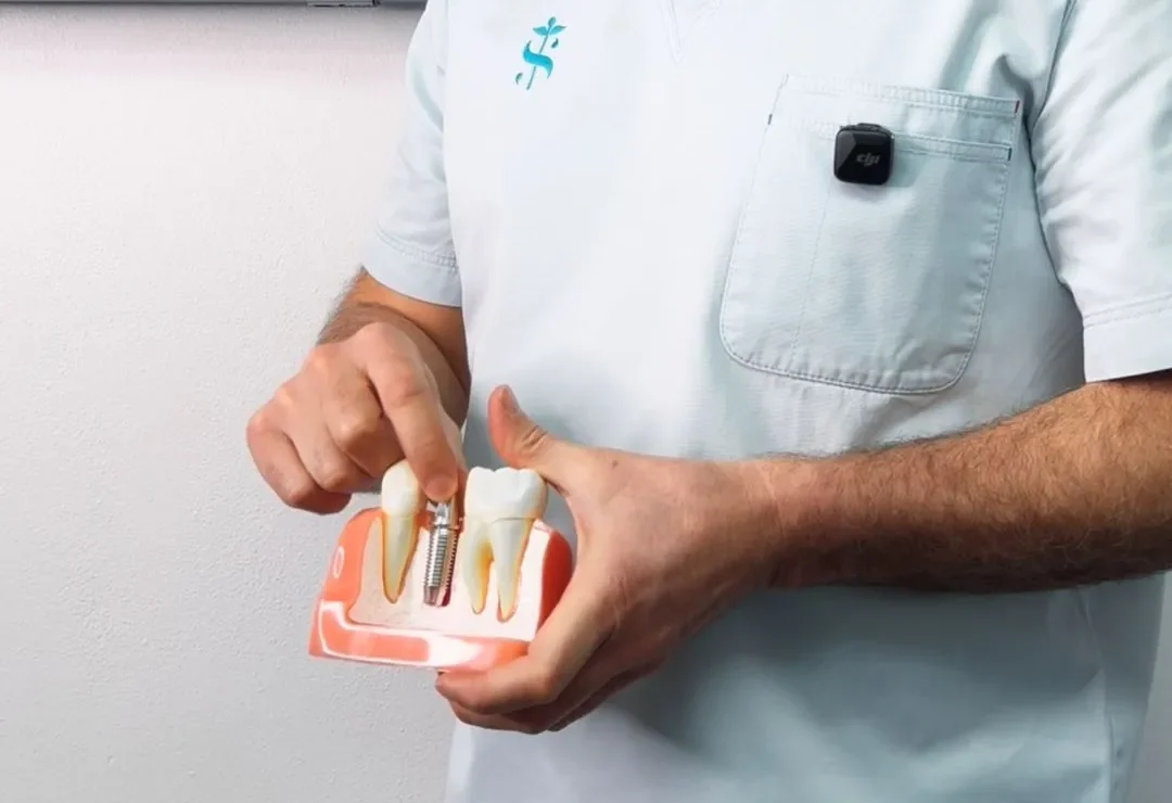 Come capire se l’impianto dentale si sta muovendo