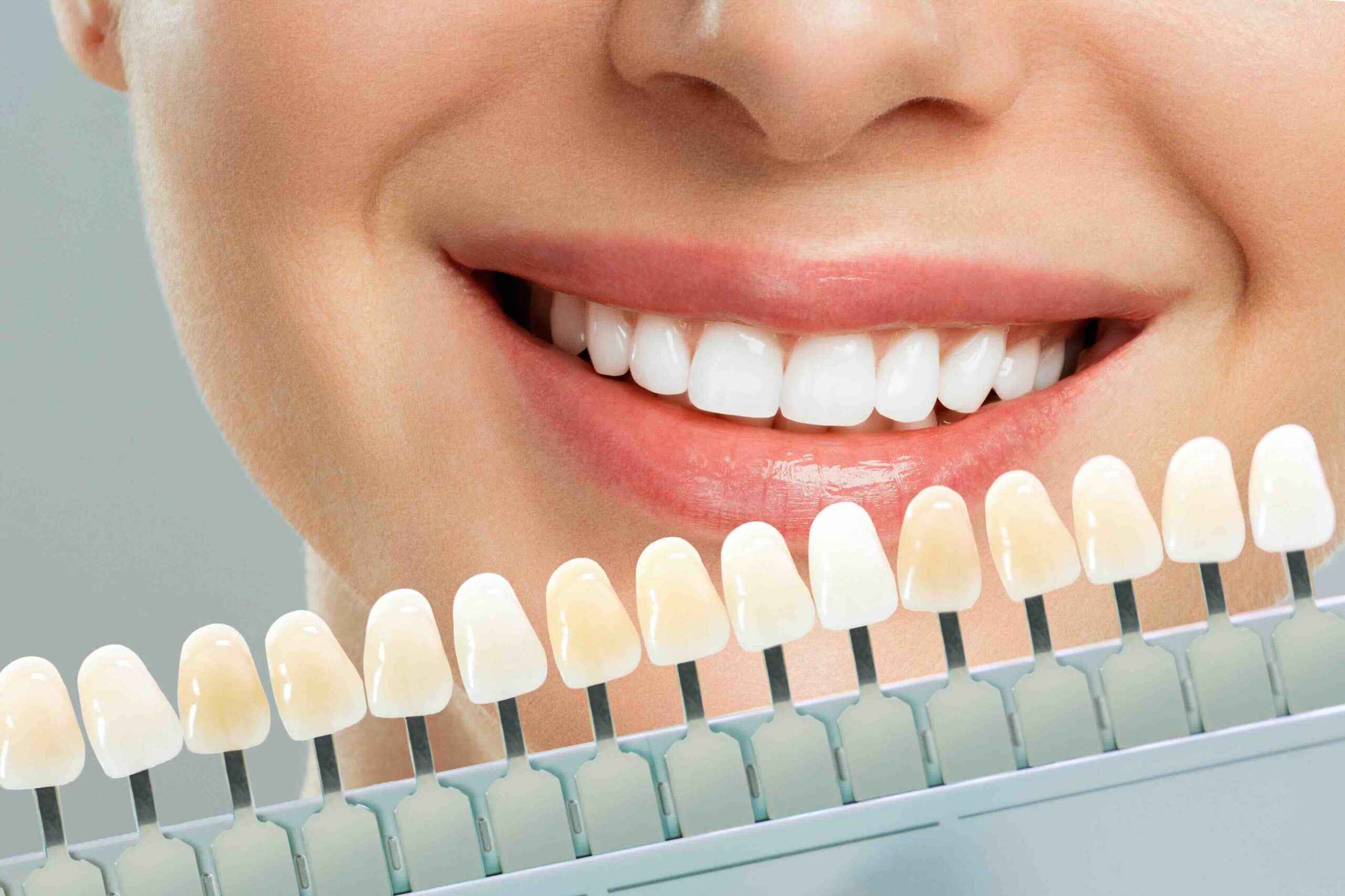 Come cambiano i denti con le faccette