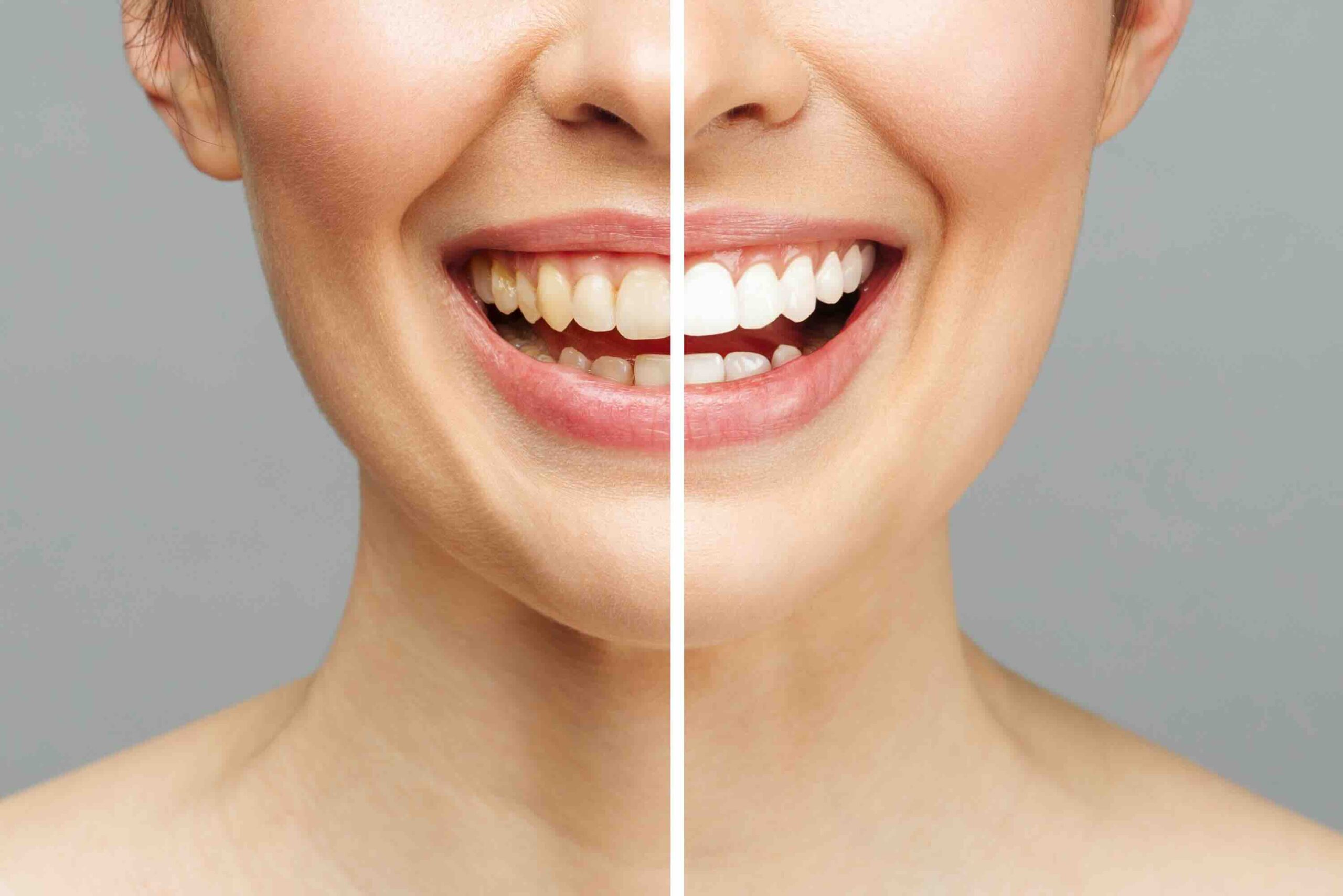 Quanto tempo resta bianco un dente sbiancato